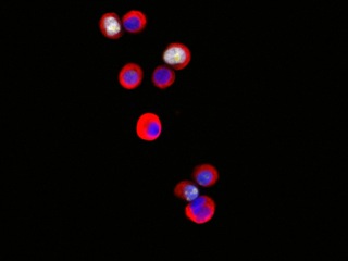 Circulating tumor cells (Image courtesy of Min Yu)