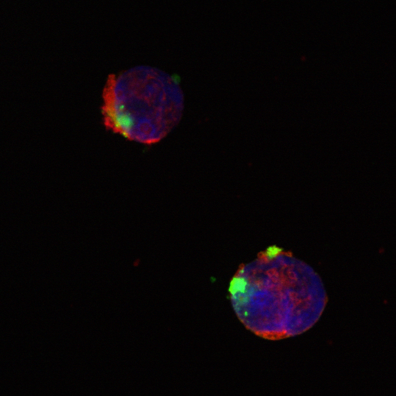 Leukemic cells (Image courtesy of Fatih Uckun)