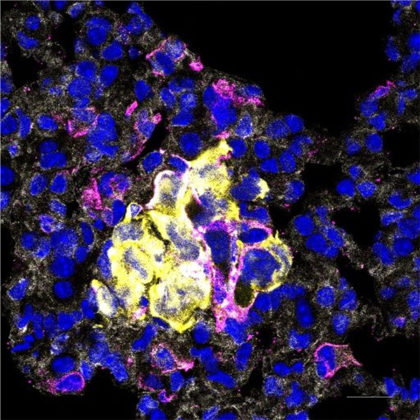 Metastatic breast cancer cells (yellow) interacting with macrophages (magenta) (Image by Oihana Iriondo/Yu Lab)