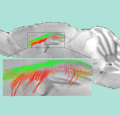 Diffusion MRI maps show disrupted white matter connectivity and loss of white matter fiber tracts in 1 year-old pericyte-deficient mice. (Image courtesy of the Zlokovic Lab)