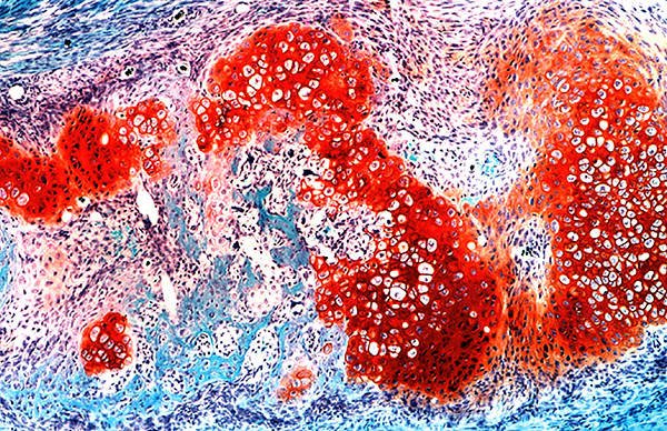 The image depicts the bridging callus that forms during large-scale rib bone repair. Cells surrounded by the orange stain (Safranin O) are special hybrid cartilage/bone cells that mediate repair. They are stimulated to participate in repair by the action of special “messenger” cells. (Image by Stephanie T. Kuwahara and Francesca Mariani/USC Stem Cell)