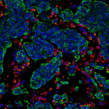 Development of brain metastasis is a complex process in which metastatic cells (green) overcome the protective effect of immune cells (red). (Image/Yu Lab, USC Stem Cell)