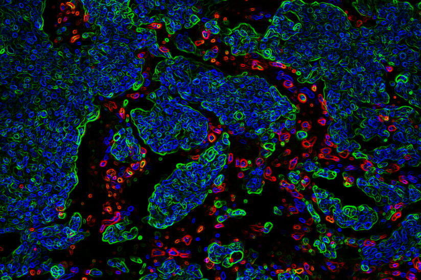 Development of brain metastasis is a complex process in which metastatic cells (green) overcome the protective effect of immune cells (red). (Image/Yu Lab, USC Stem Cell)