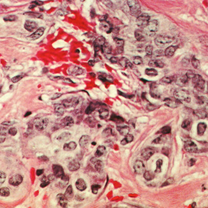 Breast cancer cells. Image/Wikimedia Commons