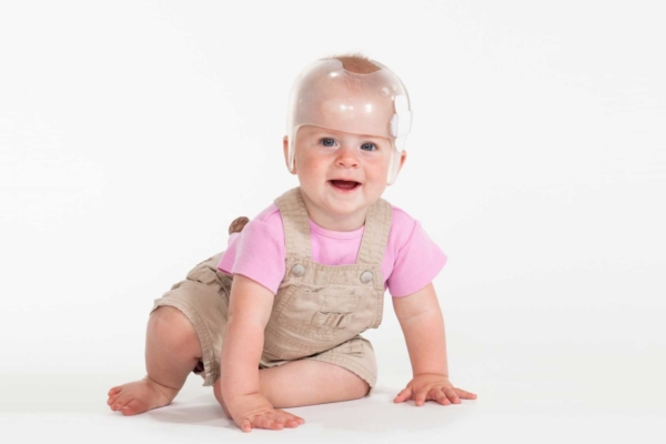 Conventional treatment for craniosynostosis often involves surgery and cranial helmets during the long recovery process. (Photo courtesy of iStock)