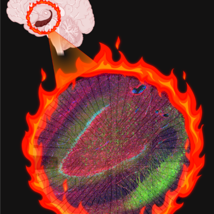 Altered cells create an electrical “fire” in patients with epilepsy. (BioRender illustration by Aswathy Ammothumkandy/Bonaguidi Lab/USC Stem Cell)