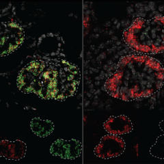 In specialized kidney cells that filter the blood (podocytes), both mouse and human cells express the gene MAFB (red) but the human kidney disease associated gene PLA2R1 is only active in human cells (green). (Image by Sunghyun Kim/McMahon lab)