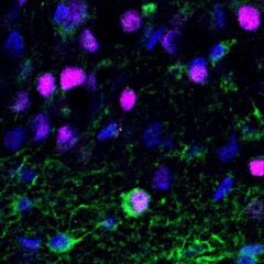 Newborn neuron (green and purple cell) in brain tissue from patients with epilepsy (Image by Aswathy Ammothumkandy/Bonaguidi Lab/USC Stem Cell)